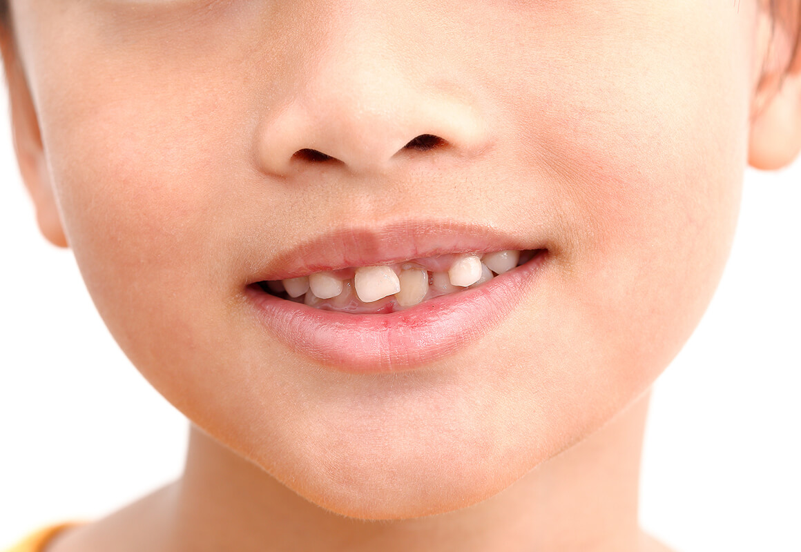 お子様の歯並びは遺伝だけではありません