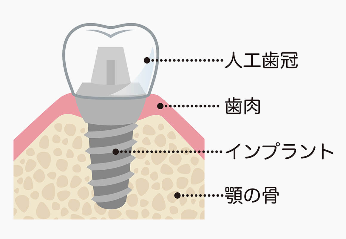 インプラントがすぐれている点