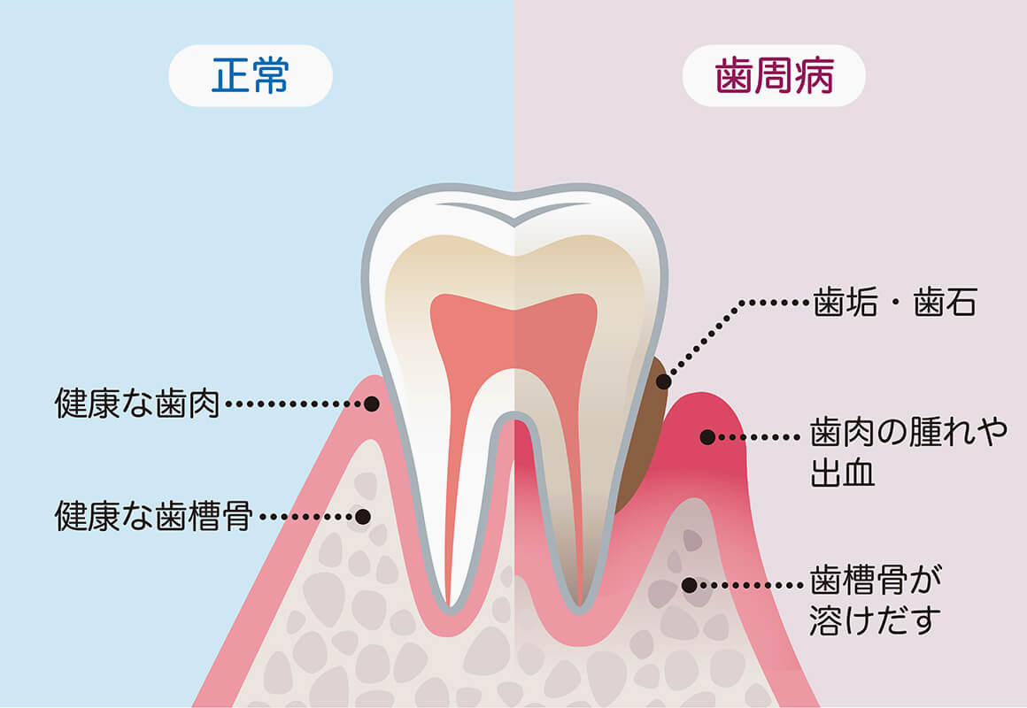 成人の8割は歯周病またはその予備軍です