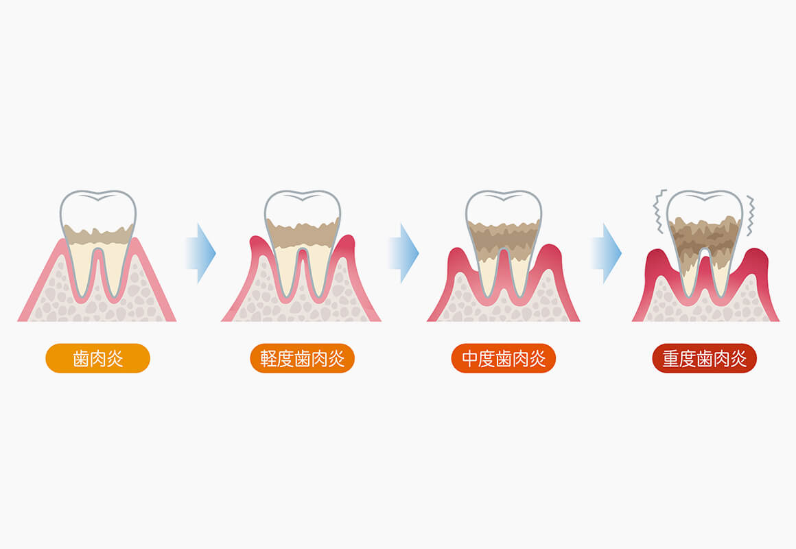 成人の8割は歯周病またはその予備軍です