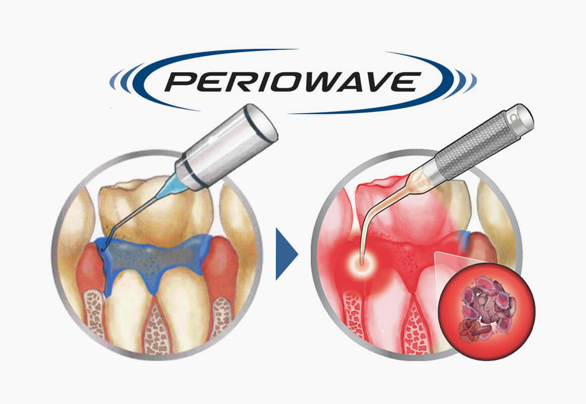 光殺菌（PDT）による歯周病治療「ペリオウェイブ」