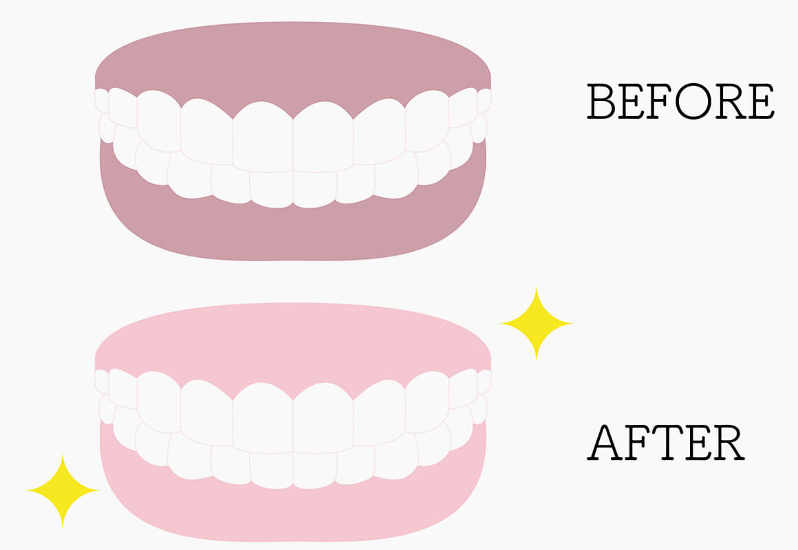 歯ぐきの黒ずみを除去するガムブリーチ